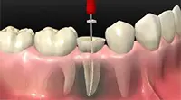 Endodoncia